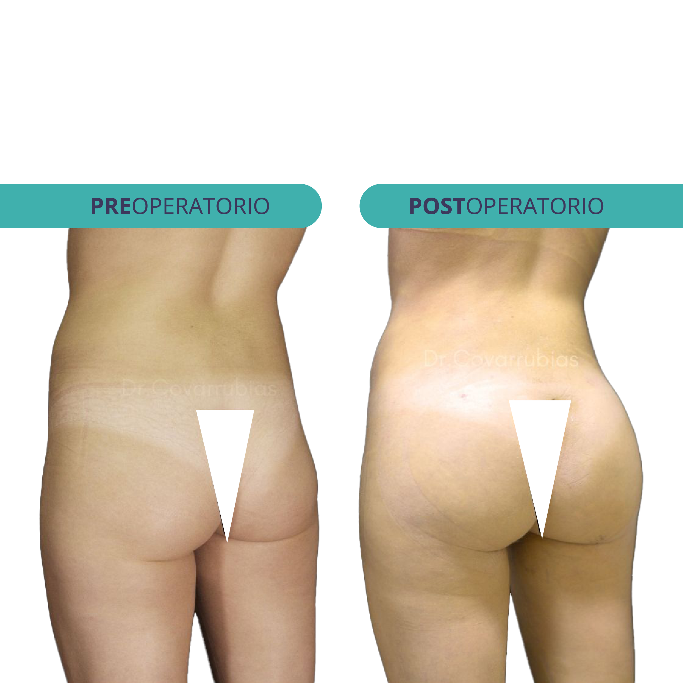 Gluteoplastia con implantes