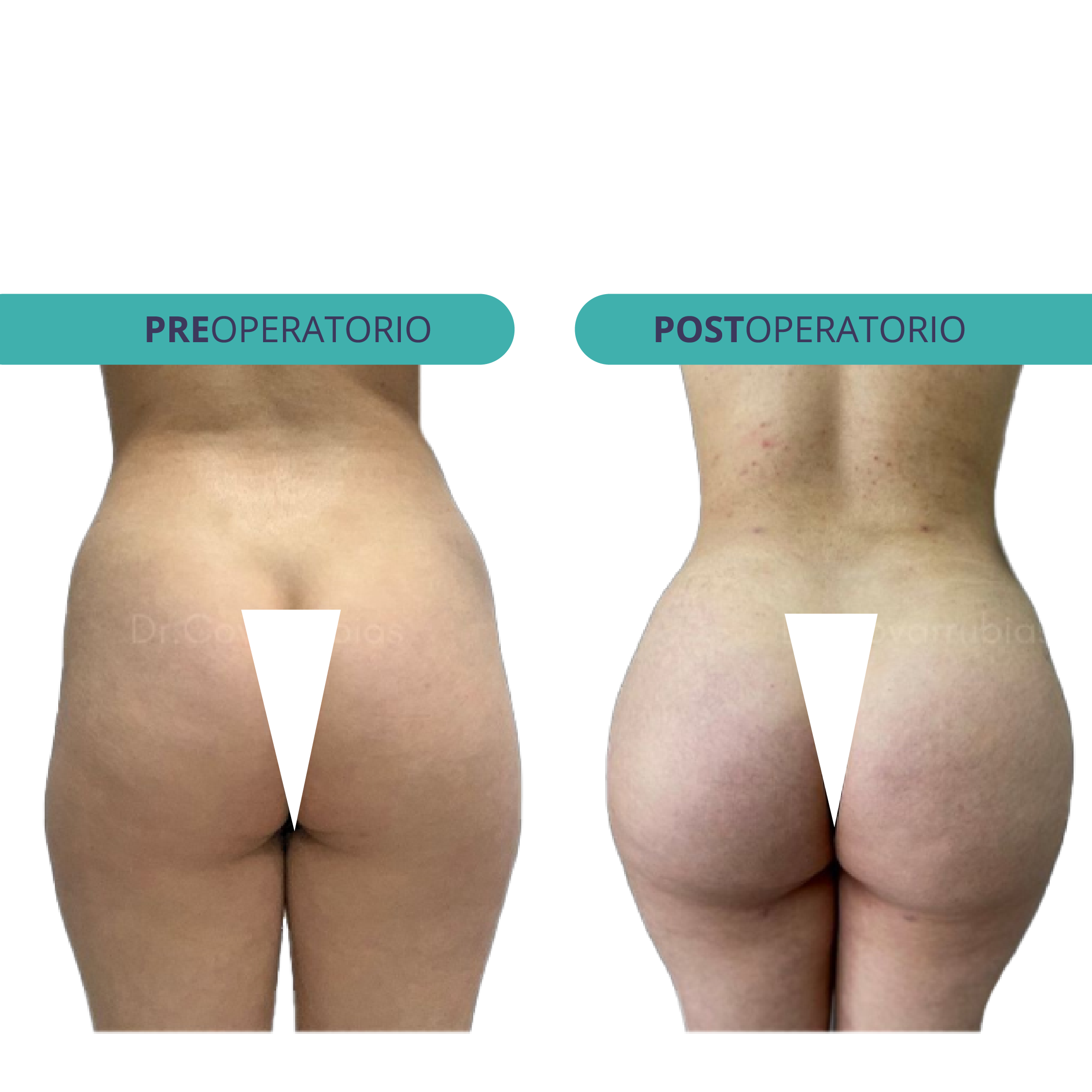 Gluteoplastia Híbrida